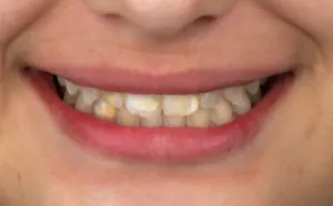 Antes - Dentes Amarelados